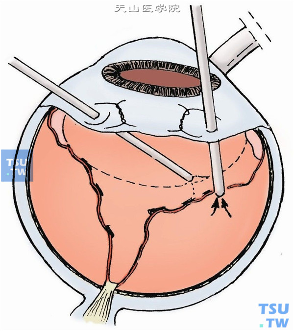 如有后部裂孔，行气液交换，输入的空气将视网膜下液推向后方，笛针置于后部裂孔前，将其吸出