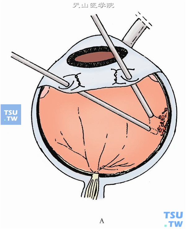 视网膜复位后，眼内激光沿裂孔边缘做2～4排光凝
