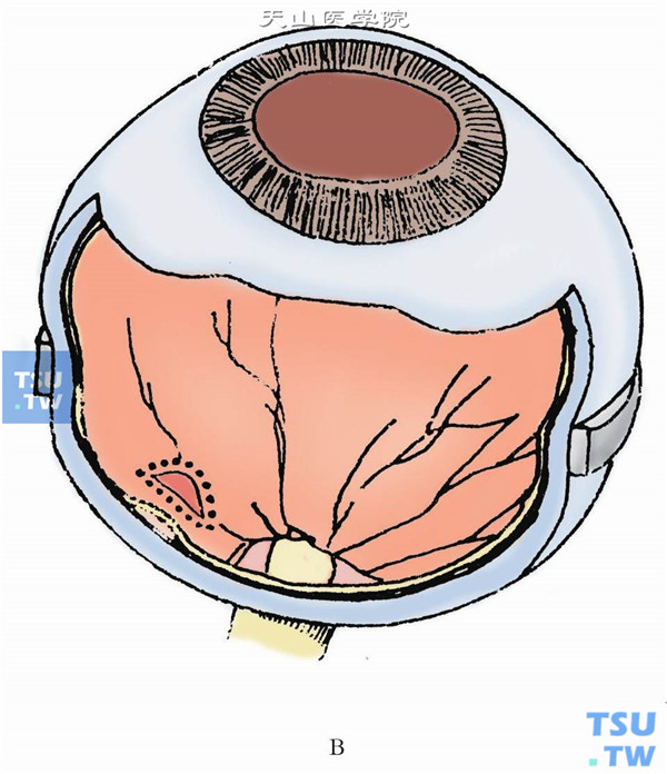 视网膜复位后，眼内激光沿裂孔边缘做2～4排光凝