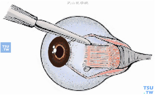 分离直肌两侧的Tenon囊并暴露巩膜面，用斜视钩牵引直肌、钝性分离肌肉周围的节制韧带