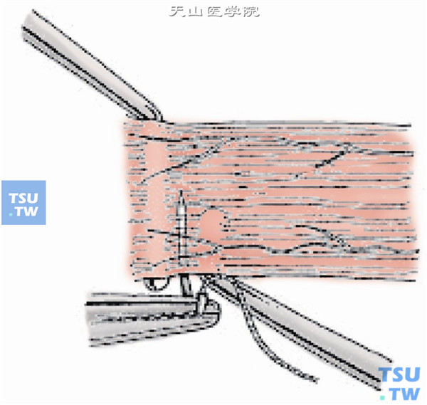 在肌肉附着点后1～1.5mm处，采用6-0可吸收线做肌腱1/3宽度的套环缝合