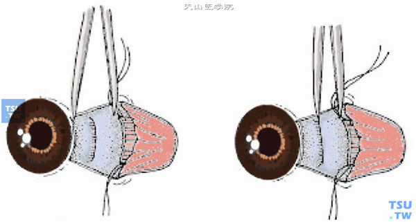 将肌腱断端上、下缘的套环线缝合于所需后退部位的巩膜板层，缝合时应与原肌肉附着处保持平行且宽度一致，进针时应确保始终可以看见针尖