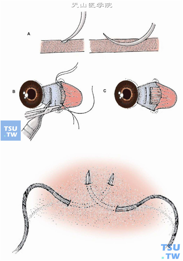 将肌腱断端上、下缘的套环线缝合于所需后退部位的巩膜板层，缝合时应与原肌肉附着处保持平行且宽度一致，进针时应确保始终可以看见针尖