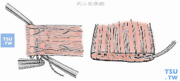 在肌肉附着点后1～1.5mm处，采用6-0可吸收线做肌腱1/3宽度的套环缝合