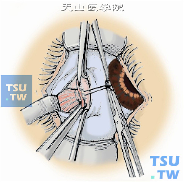 将肌腱断端上、下缘的套环线缝合于原附着处，根据术前设计前后移动直肌至合适位置后将缝线打结