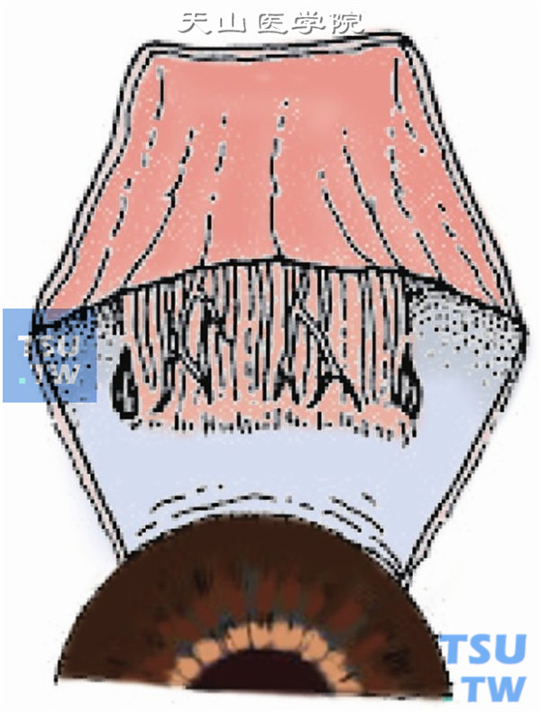 在需手术肌肉周围做一平行于角膜缘、长约1cm的结膜切口或采取角膜缘梯形结膜切口