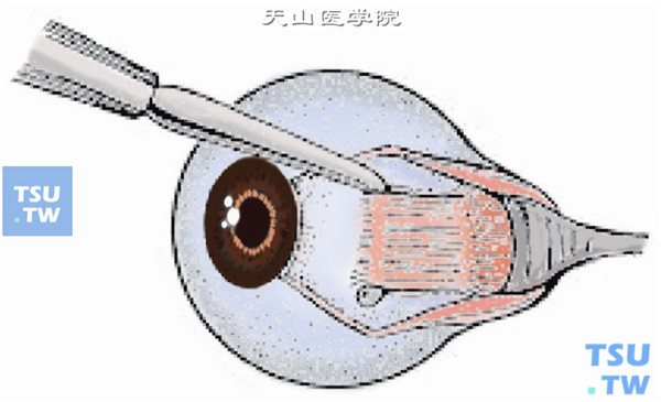 分离直肌两侧的Tenon囊并暴露巩膜面，用斜视钩牵引直肌、钝性分离肌肉周围的节制韧带，并将直肌一直暴露至赤道后