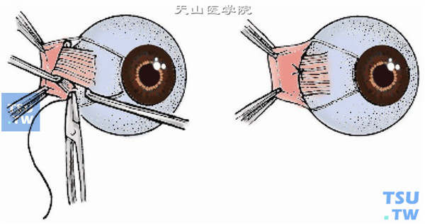 在肌肉附着点后12～15mm处，采用6-0可吸收线做肌腱1/3宽度的套环缝合并将其固定于巩膜壁