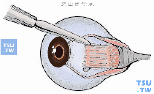 分离直肌两侧的Tenon囊并暴露巩膜面，用斜视钩牵引直肌、钝性分离肌肉周围的节制韧带