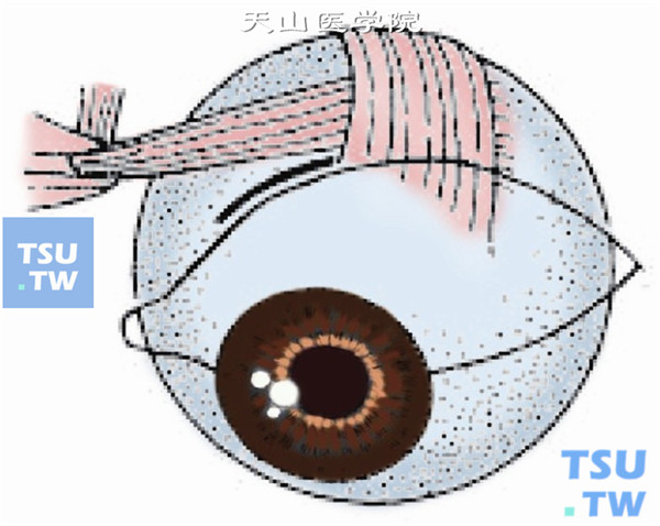 斜视矫正：上斜肌断腱术操作及临床经验