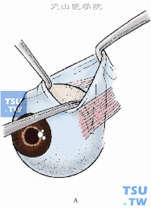 用2把斜视钩分别暴露上直肌和内直肌，再以一斜视钩沿上直肌附着点鼻侧缘轻顶巩膜向后方伸入约10mm，将斜视钩反转，尖端向上直对眶上壁向切口滑动，若所牵引出的肌腱可以使眼球向内下转动，则确认上斜肌肌腱