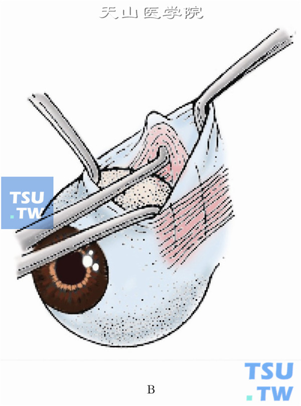 用2把斜视钩分别暴露上直肌和内直肌，再以一斜视钩沿上直肌附着点鼻侧缘轻顶巩膜向后方伸入约10mm，将斜视钩反转，尖端向上直对眶上壁向切口滑动，若所牵引出的肌腱可以使眼球向内下转动，则确认上斜肌肌腱