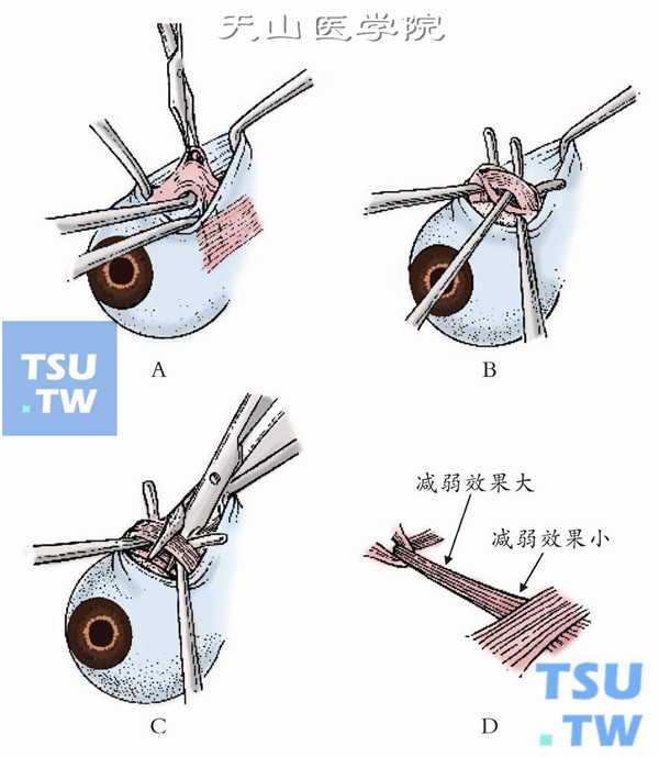 分离上斜肌周围筋膜组织，暴露上斜肌及肌鞘。纵行剪开肌鞘前壁可见上斜肌肌腱为珠光色带状组织。用斜视钩勾起裸露肌腱后将其剪断。若行部分腱切除术，可以同时剪除3～8mm长的肌腱