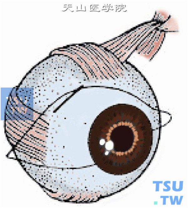 将眼球向下方牵引，在上直肌附着点颞侧做结膜切口，长约10mm。自结膜面向后分离Tenon囊、肌间膜，充分暴露巩膜