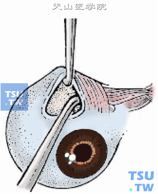 用一斜视钩勾住上直肌止端向下牵拉眼球，再以另一斜视钩牵拉球结膜切口后缘向颞上方牵拉，暴露上斜肌附着点