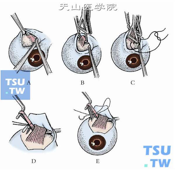 沿上直肌颞侧、紧贴巩膜向后将上斜肌及其腱鞘一并分离出。根据术前手术设计所需的折叠量，将肌肉连同肌鞘用折叠器或斜视钩勾起，并在折叠处用6-0可吸收线做肌腱1/3宽度的套环缝合