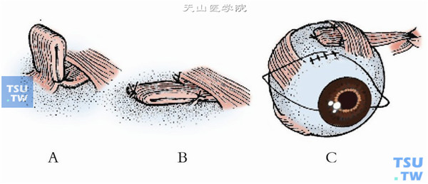 将折叠的头部，按上斜肌附着点走行平铺，并缝合于巩膜表面