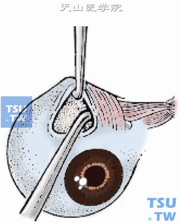 用一斜视钩勾住上直肌止端向下牵拉眼球，再以另一斜视钩牵拉球结膜切口后缘向颞上方牵拉，暴露上斜肌附着点