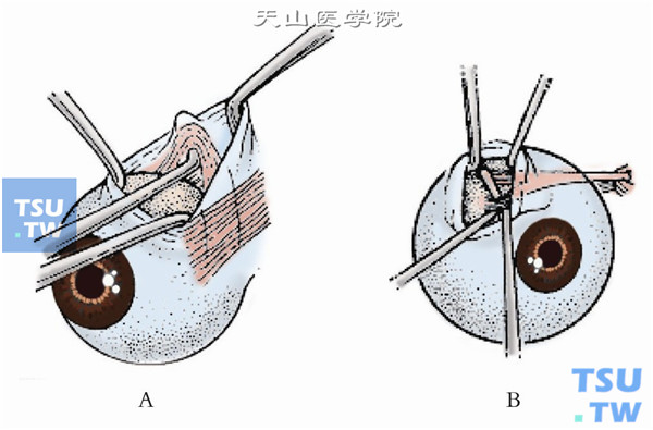 沿上直肌颞侧、紧贴巩膜向后将上斜肌及其腱鞘一并分离，用一小斜视钩将上斜肌肌腱劈为前后两部