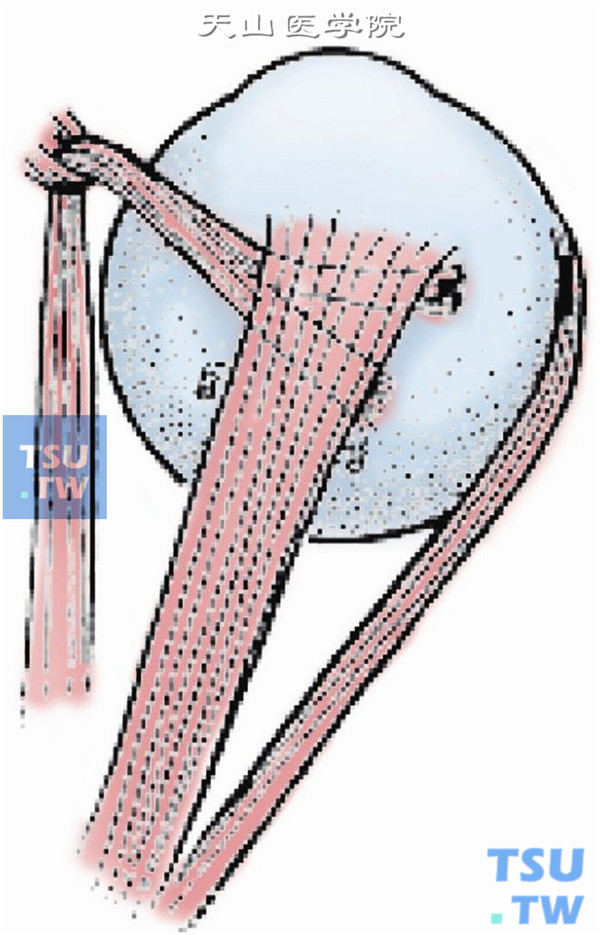 在附着点处剪断前部肌腱，并将其缝合于上直肌附着点颞侧4mm、前部4～6mm巩膜表面