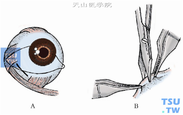 在颞下穹窿做一平行于角膜缘、长约1cm的结膜切口，将切口穿过Tenon囊并直达巩膜