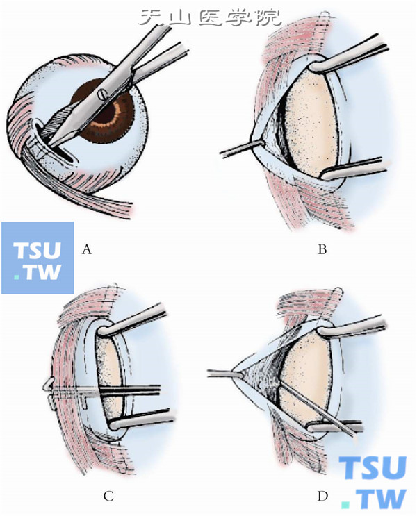 双手各持一把有钩镊，以接力方式依次暴露切口下方的结膜下组织，直至发现位于Tenon囊内、粉红色的下斜肌纤维
