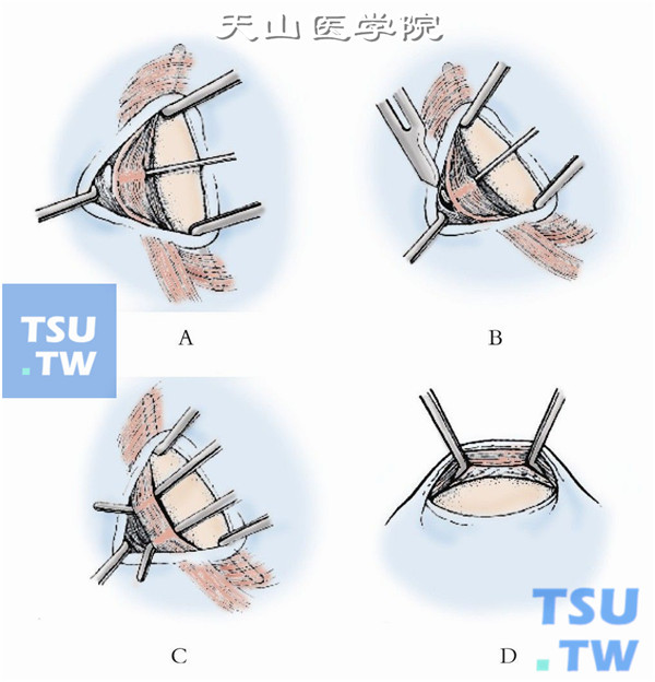 以斜视钩穿过下斜肌肌腹，充分游离暴露下斜肌肌腹部