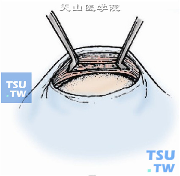 以斜视钩穿过下斜肌肌腹，充分游离暴露下斜肌肌腹部