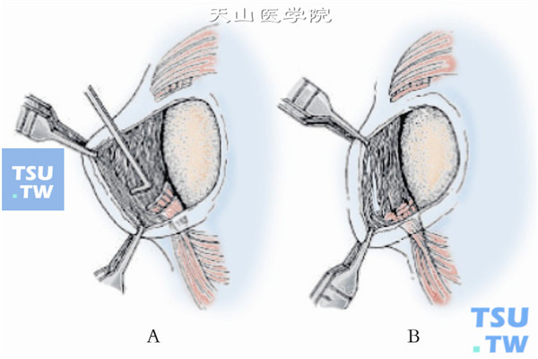 检查并确认无下斜肌纤维残留，轻轻将下斜肌推向内下方的结膜下内