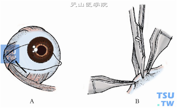 斜视手术：下斜肌后徙术操作及临床经验