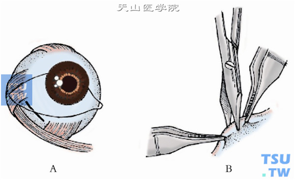 在颞下穹窿做一平行于角膜缘、长约1cm的结膜切口，将切口穿过Tenon囊并直达巩膜
