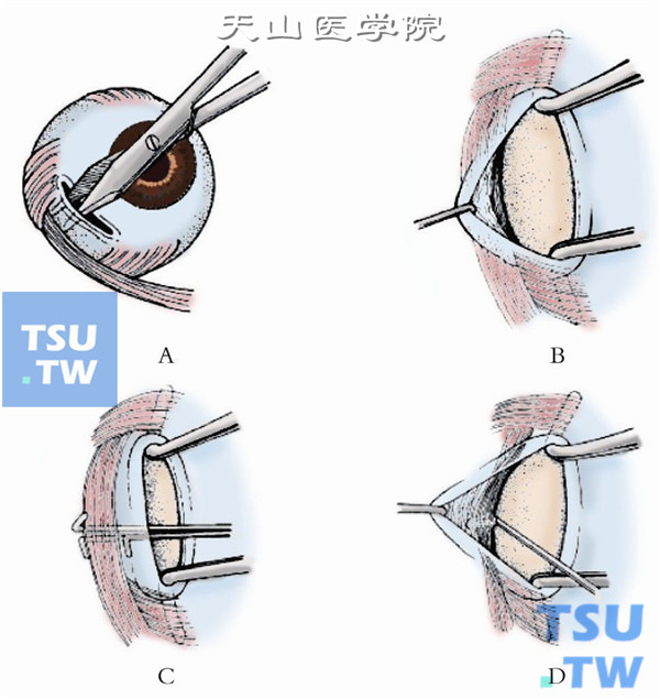 斜视手术步骤图解图片