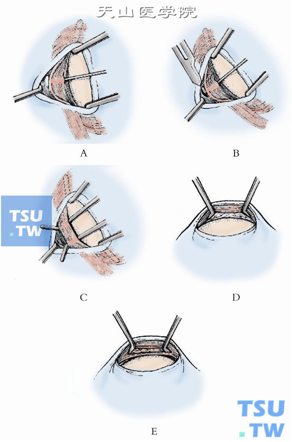 以斜视钩穿过下斜肌肌腹，充分游离暴露下斜肌肌腹部