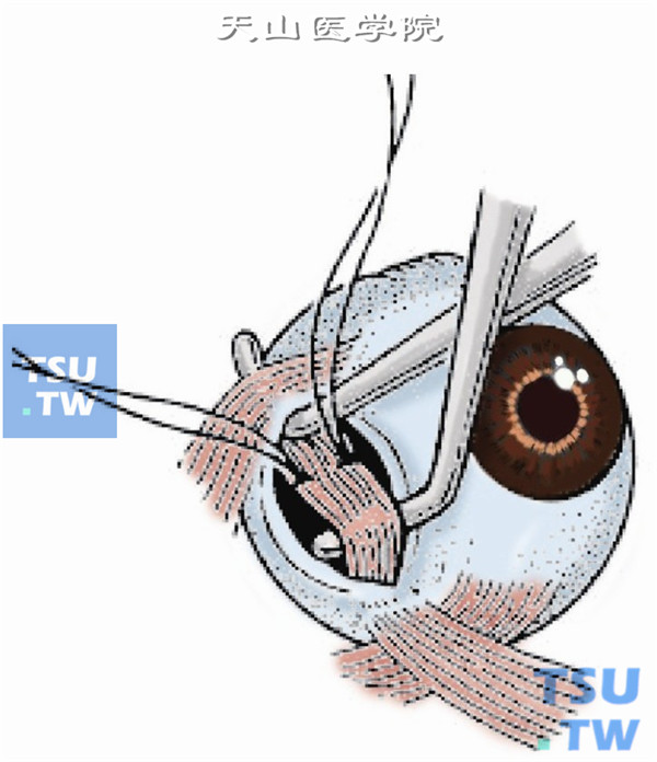 近外直肌下缘附近下斜肌附着点后1～1.5mm处，用6-0可吸收线做肌腱1/3宽度的套环缝合