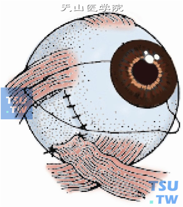 近外直肌下缘附近下斜肌附着点后1～1.5mm处，用6-0可吸收线做肌腱1/3宽度的套环缝合