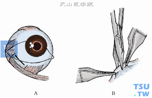 斜视手术：下斜肌前转位术操作及注意事项