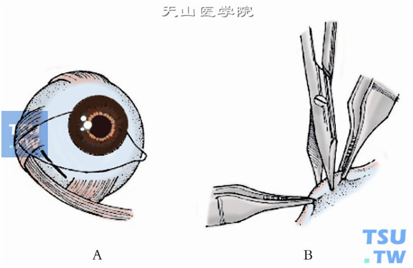 在颞下穹窿做一平行于角膜缘、长约1cm的结膜切口，将切口穿过Tenon囊并直达巩膜