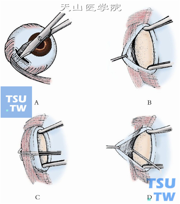 双手各持一把有齿镊，以接力方式依次暴露切口下方的结膜下组织，直至发现位于Tenon囊内、粉红色的下斜肌纤维