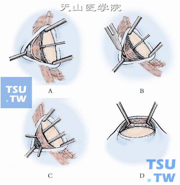 以斜视钩穿过下斜肌肌腹，充分游离暴露下斜肌肌腹部