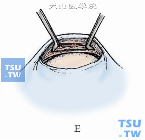 以斜视钩穿过下斜肌肌腹，充分游离暴露下斜肌肌腹部