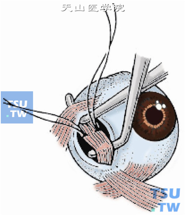 近外直肌下缘附近下斜肌附着点后1～1.5mm处，用6-0可吸收线做肌腱1/3宽度的套环缝合
