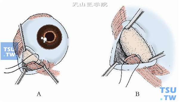 近外直肌下缘附近下斜肌附着点后1～1.5mm处，用6-0可吸收线做肌腱1/3宽度的套环缝合