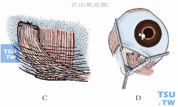 预置缝线前剪断下斜肌，将下斜肌前部纤维固定于下直肌止端水平颞侧，下斜肌后部纤维根据垂直偏斜的程度，分别固定于下直肌止端水平后1mm、下直肌止端水平或下直肌止端前1mm