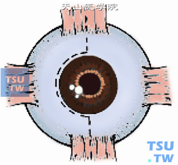在外直肌附着点附近做一横跨肌肉平面、平行于角膜缘长约1.5cm的结膜切口或采取角膜缘梯形结膜切口，范围从5点经9点至1点时钟位
