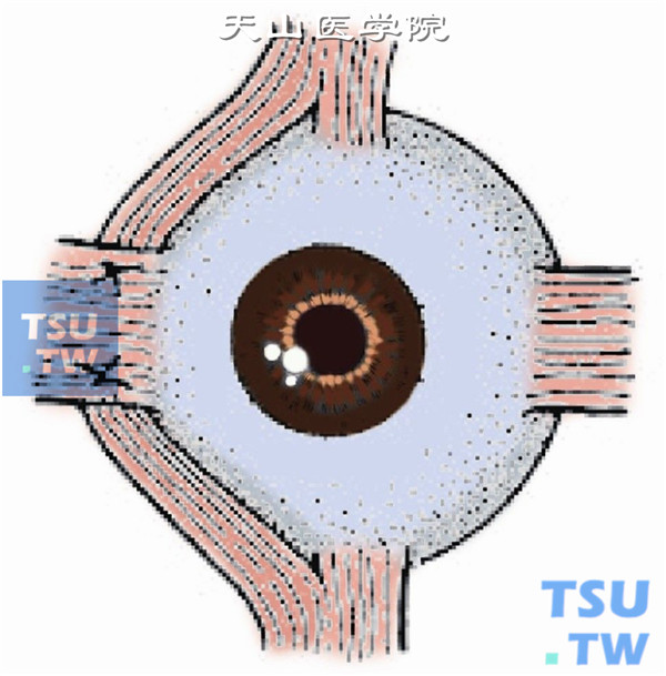 将上、下直肌断端分别缝合于外直肌附着点上、下侧缘的巩膜