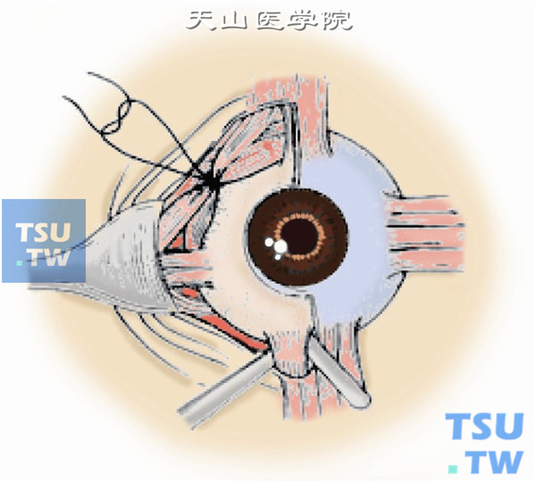 用4-0尼龙线将外直肌上半与上直肌颞半侧、外直肌下半与下直肌颞半侧在眼球赤道部结扎