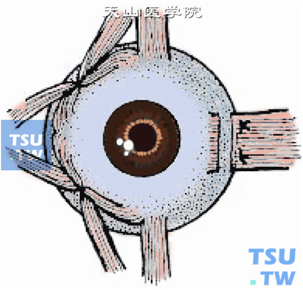 如果麻痹肌的拮抗肌有痉挛限制了麻痹肌的转动（牵拉试验阳性），则做一小角膜缘结膜切口，将内直肌后徙