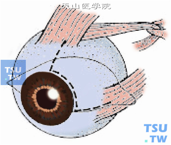 将眼球向下方牵引，在上直肌附着点鼻侧做结膜切口，长约10～15mm直至内直肌附着点上缘。自结膜面向后分离Tenon囊、肌间膜，充分暴露巩膜