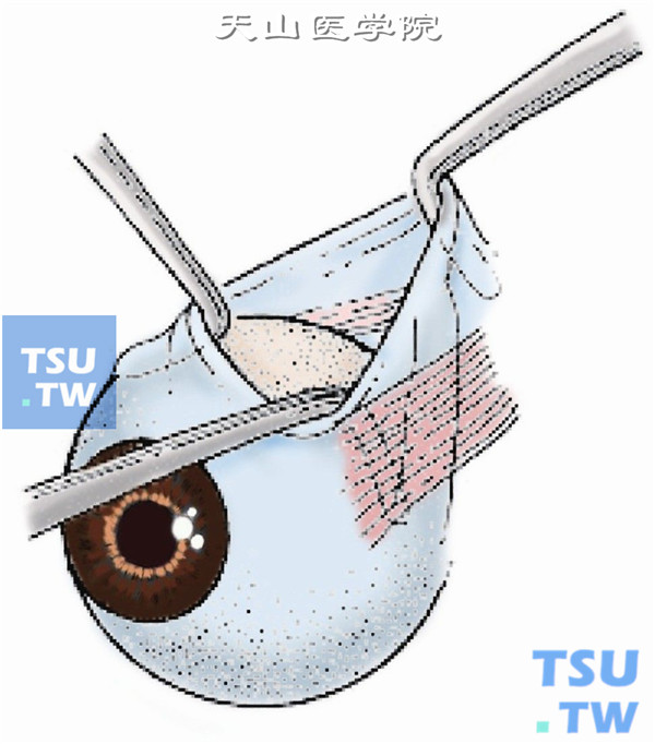 用2把斜视钩分别暴露上直肌和内直肌，再以一斜视钩沿上直肌附着点鼻侧缘轻顶巩膜向后方伸入约10mm，将斜视钩反转，尖端向上直对眶上壁向切口滑动
