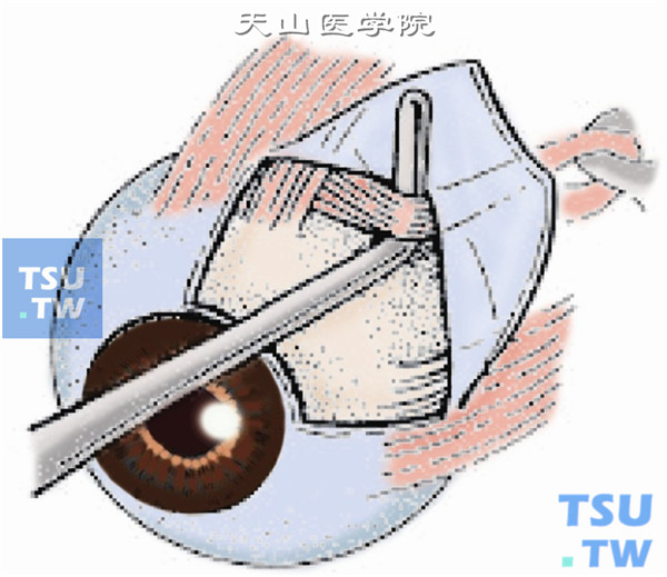 斜视：动眼神经麻痹矫正术操作及注意事项